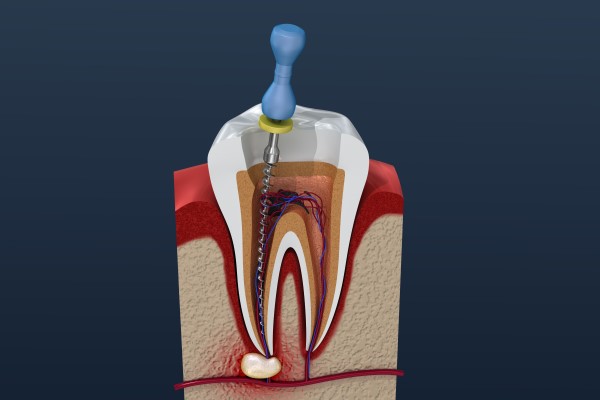 Root Canal: FAQs