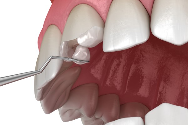 Getting Immediate Care For A Cracked Tooth