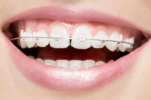 Clear Braces And The Aftercare Needed To Maintain Them