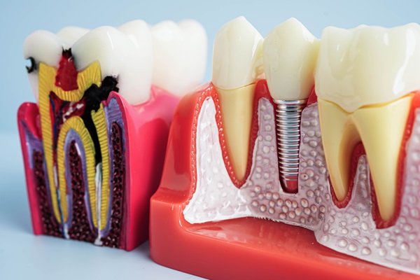 Material Options For Dental Crowns