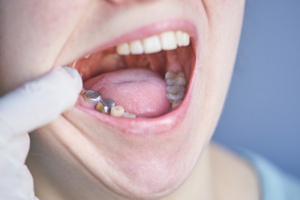 A Guide To The Dental Sealants Process By A Family Dentist
