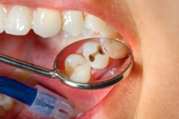 Common Types Of Cavities