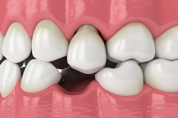 Common Techniques For Replacing Lost Teeth