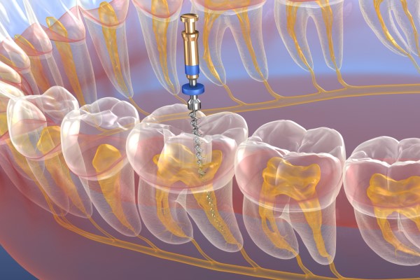 Root Canal Treatment Benicia, CA