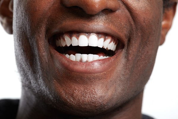 Teeth Whitening Treatment From Your Dentist